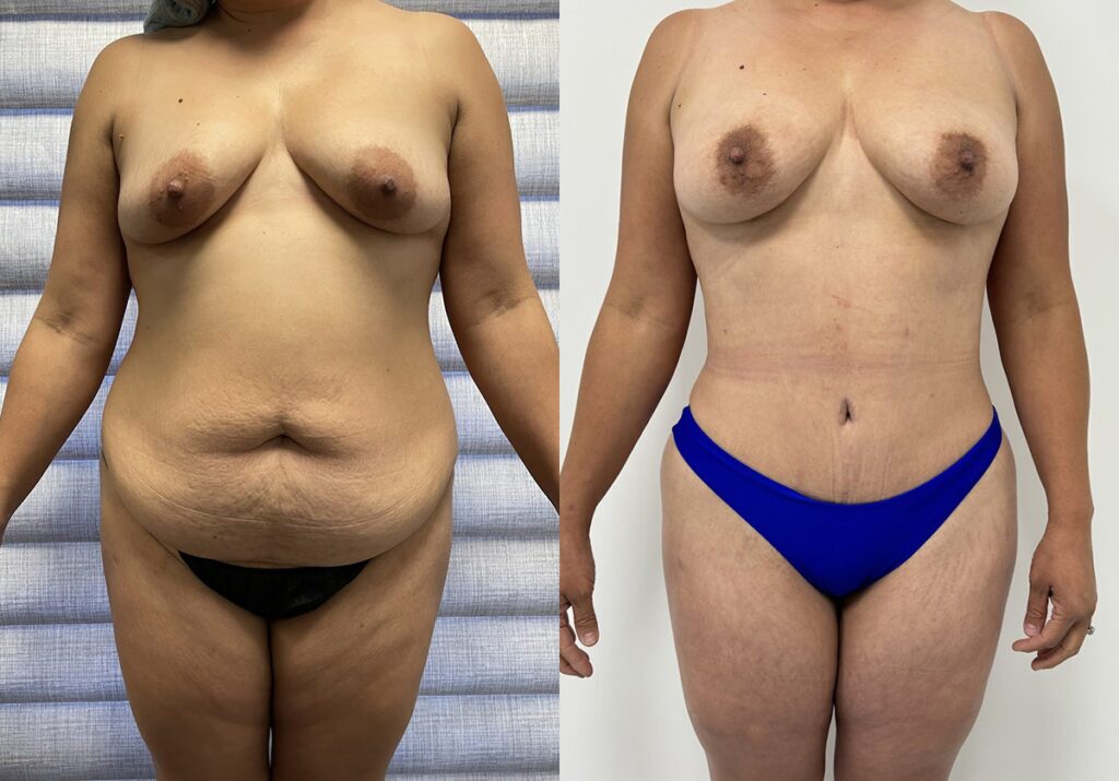 Mommy Makeover Before and After Photo by Jacobson Plastic Surgery in Beverly Hills CA