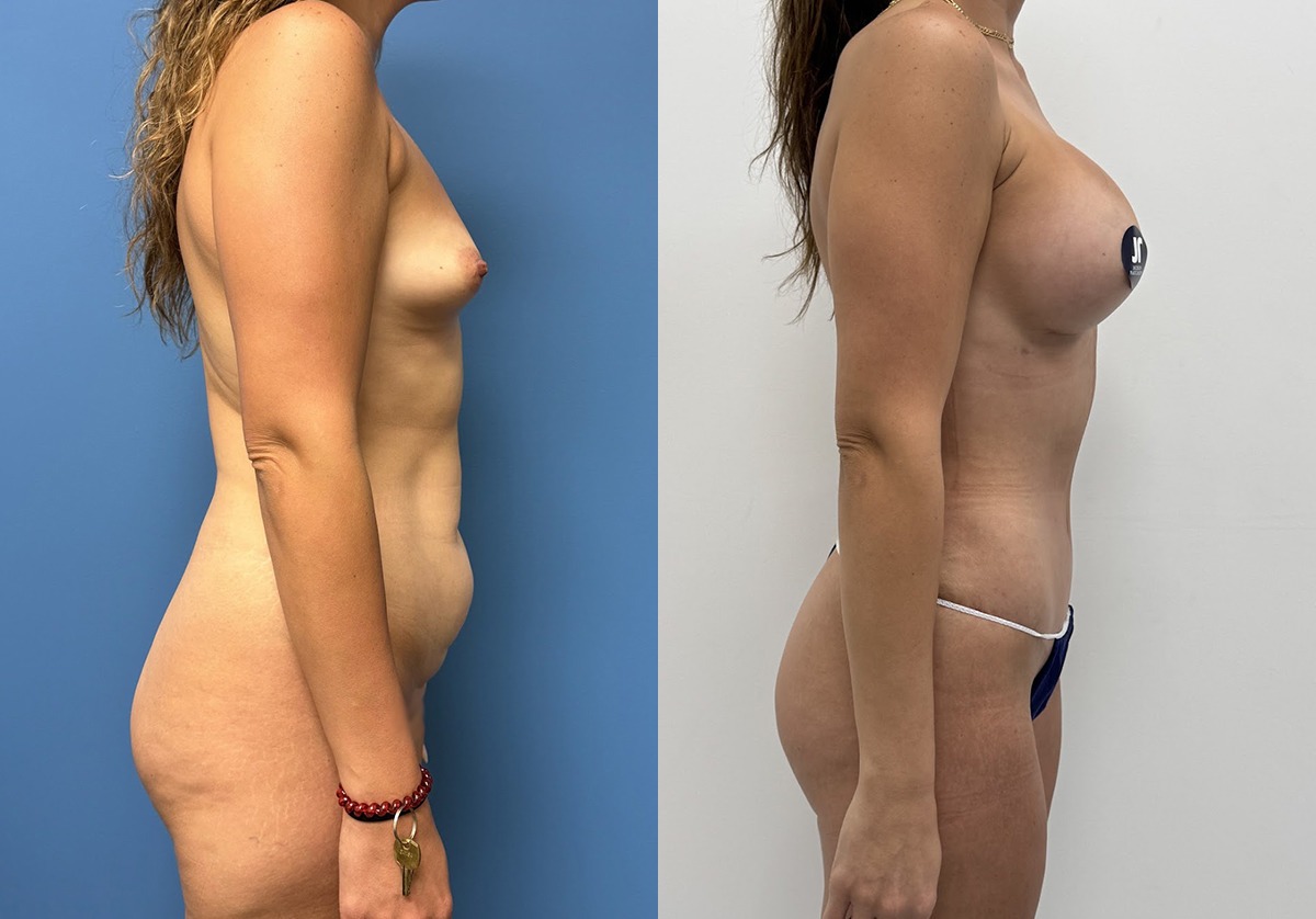 Mommy Makeover Before and After Photo by Jacobson Plastic Surgery in Beverly Hills CA