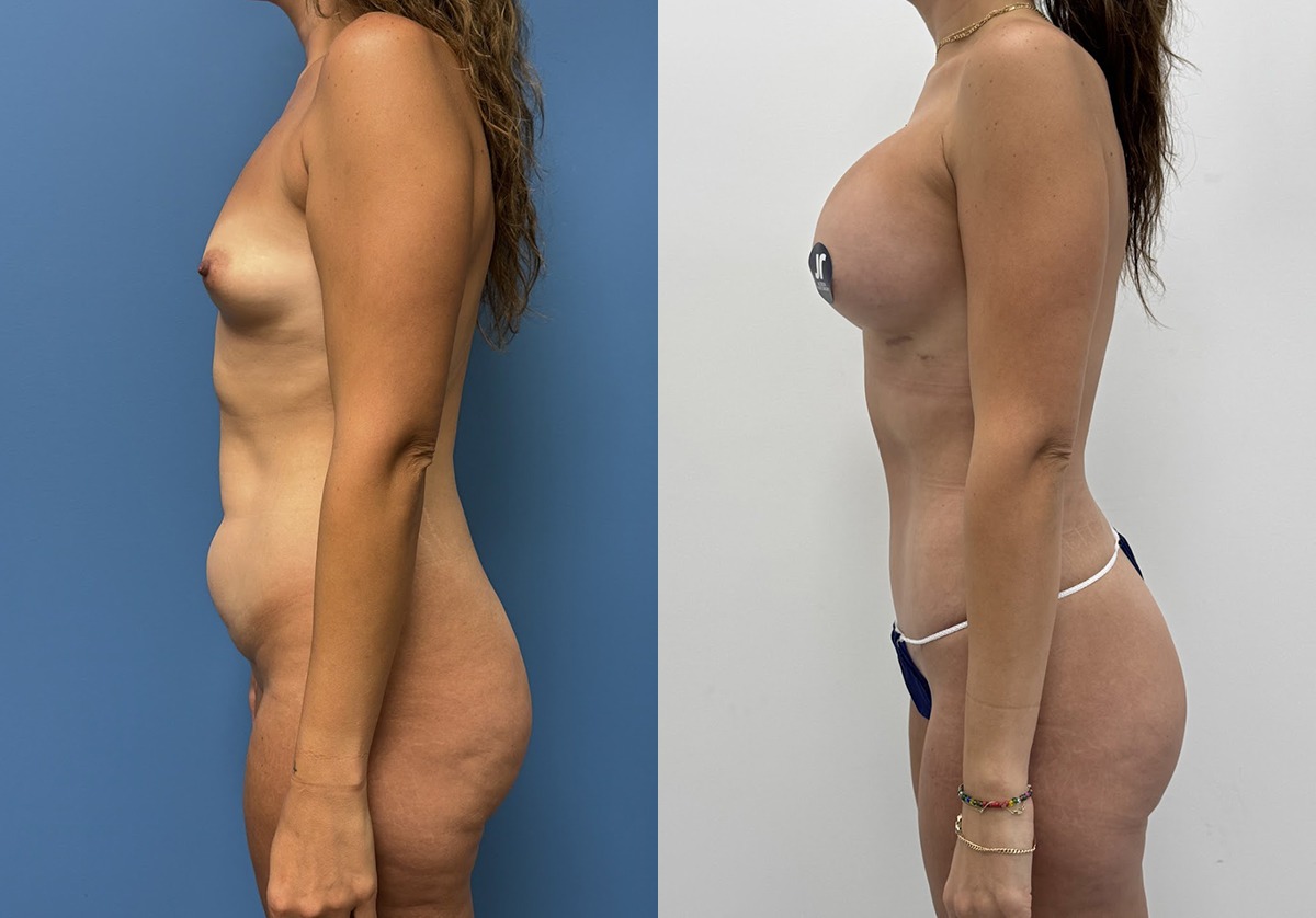 Mommy Makeover Before and After Photo by Jacobson Plastic Surgery in Beverly Hills CA