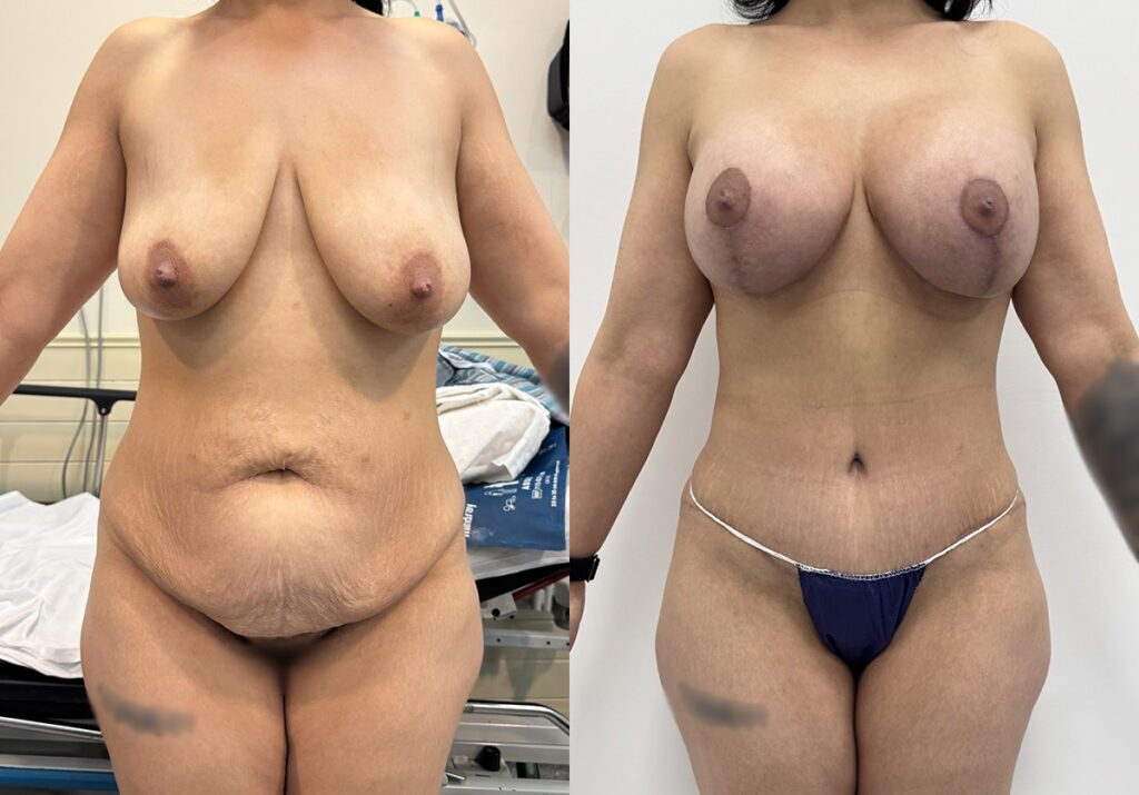 Mommy Makeover Before and After Photo by Jacobson Plastic Surgery in Beverly Hills CA