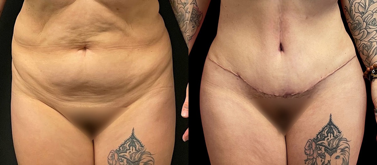 Hi-Def Liposuction Before and After Photo by Dr. Jacobson in Beverly Hills California