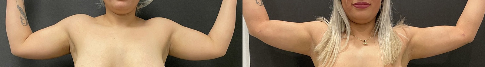 Arm Lipo Before and After Photo by Dr. Jacobson in Beverly Hills California Arm Lipo Before and After Photo by Dr. Jacobson in Beverly Hills California
