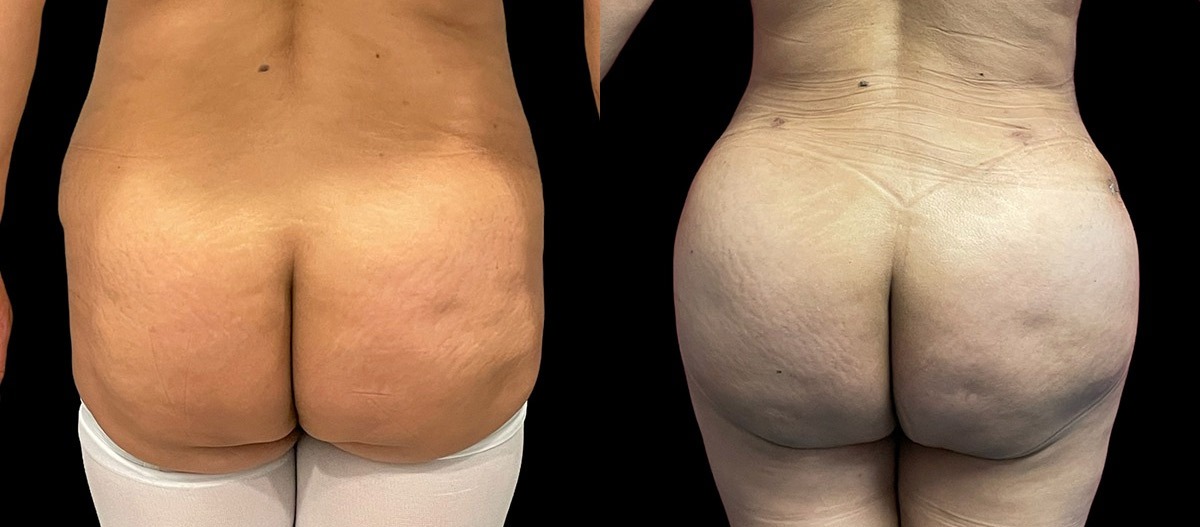 Brazilian Buttock Lift Before and After Photo by Dr. Jacobson in Beverly Hills California Brazilian Buttock Lift Before and After Photo by Dr. Jacobson in Beverly Hills California