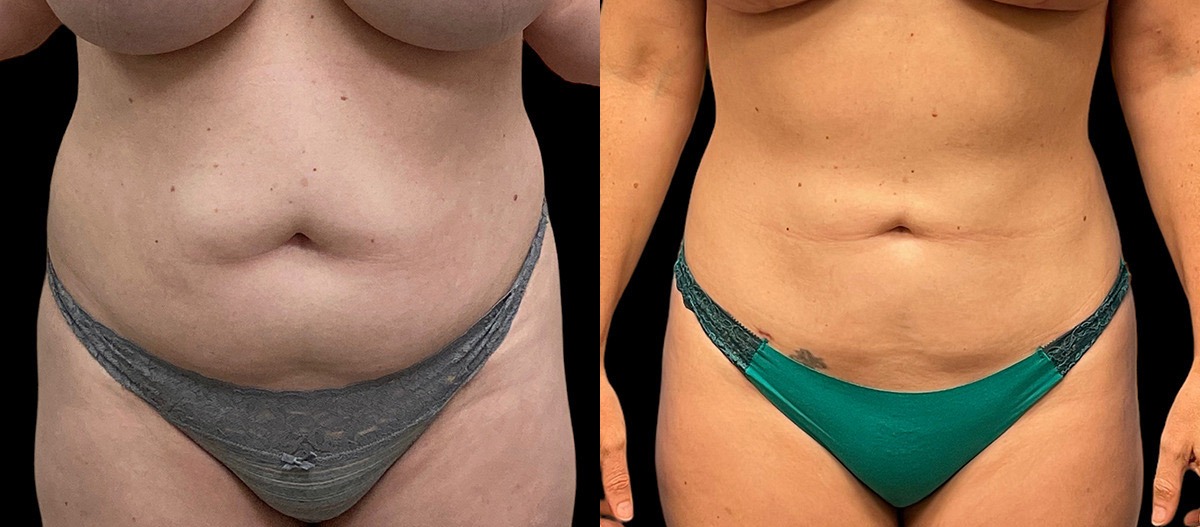 vaser liposuction before and after patient at Jacobson Plastic Surgery located in Beverly Hills, CA vaser liposuction before and after patient at Jacobson Plastic Surgery located in Beverly Hills, CA