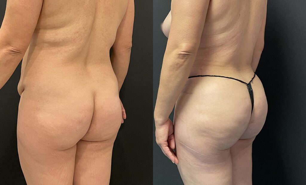 Brazilian Buttock Lift Before and After Photo by Dr. Jacobson in Beverly Hills California
