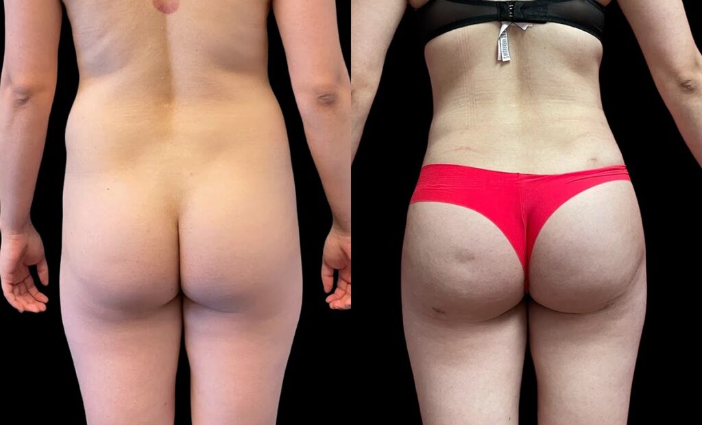 BBL Before and After Photo by Dr. Jacobson in Beverly Hills California