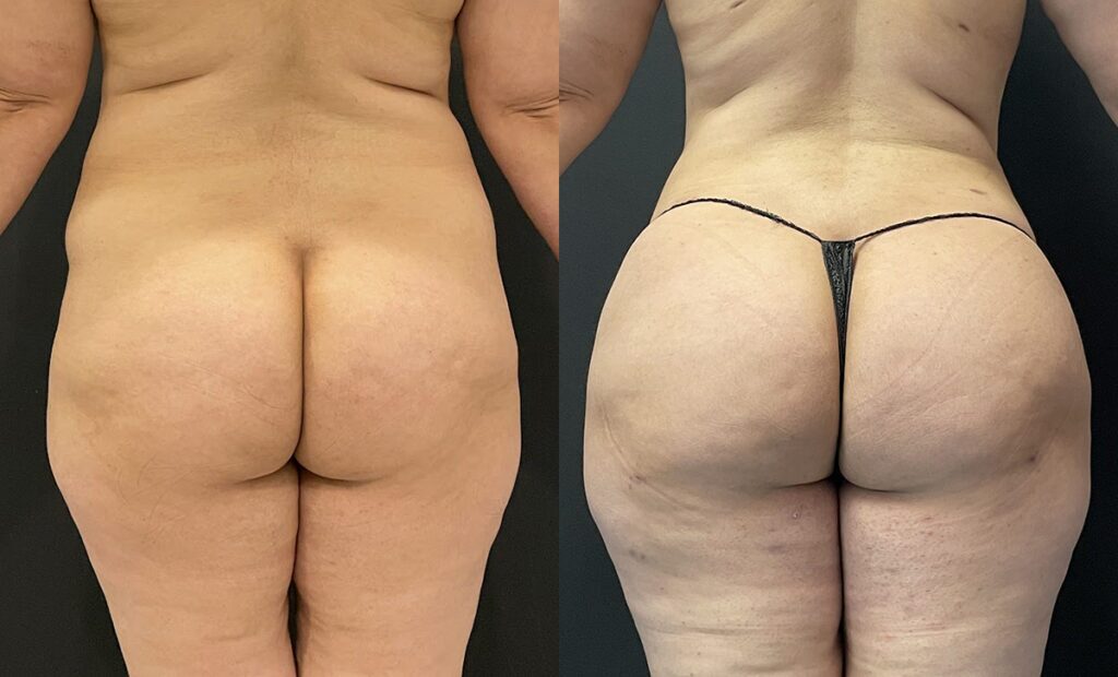 Brazilian Buttock Lift Before and After Photo by Dr. Jacobson in Beverly Hills California