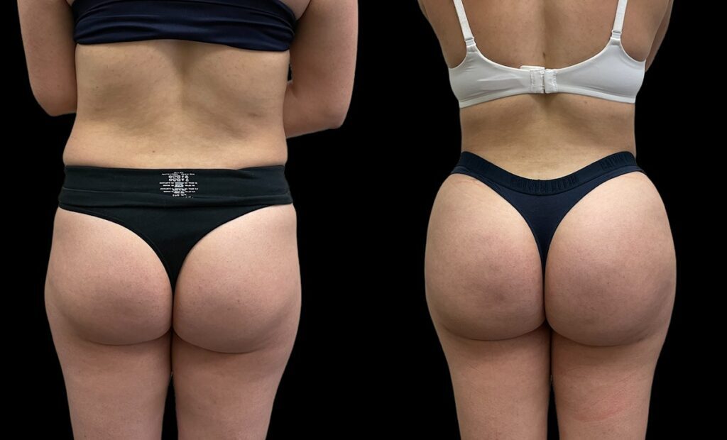 Brazilian Buttock Lift Before and After Photo by Dr. Jacobson in Beverly Hills California