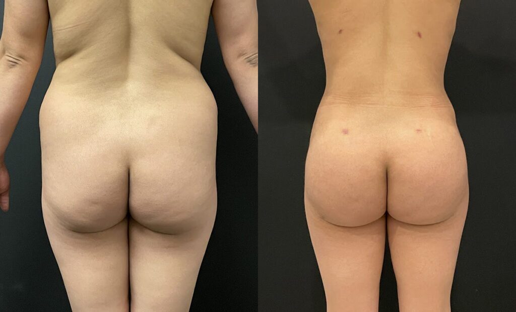 Brazilian Buttock Lift Before and After Photo by Dr. Jacobson in Beverly Hills California