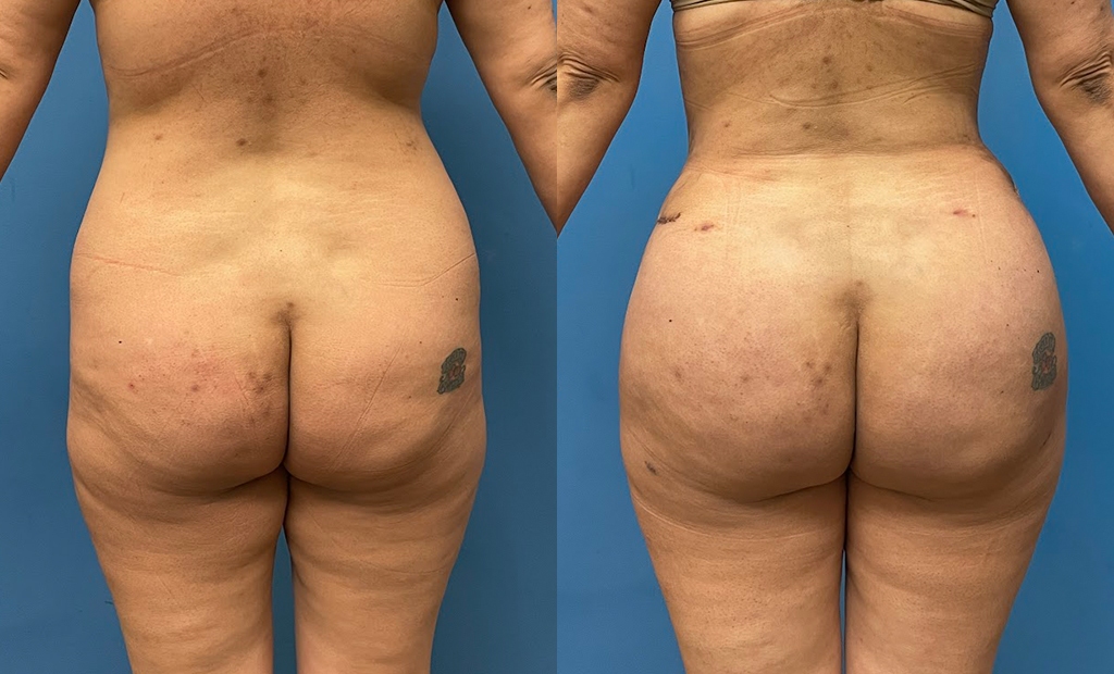 brazilian butt lift Before and After Photo by Dr. Jacobson in Beverly Hills California