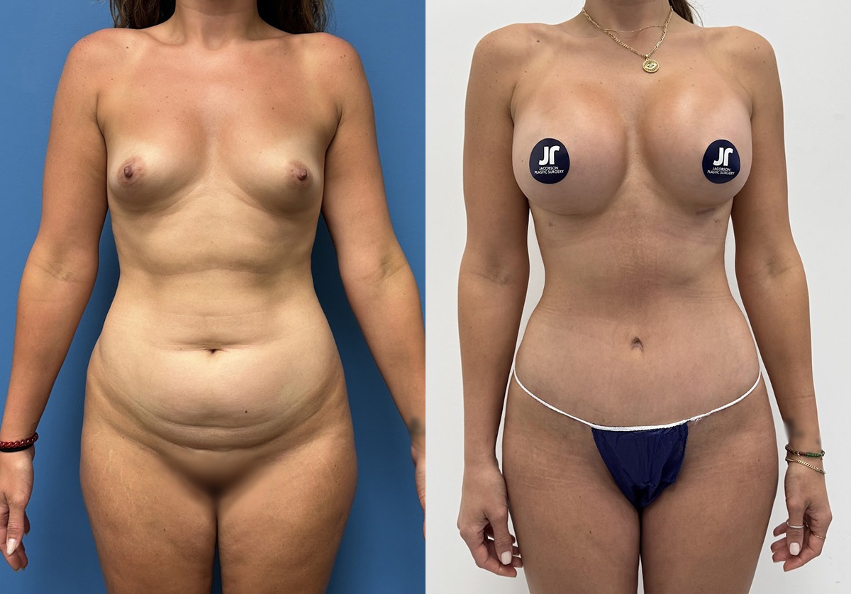 Mommy Makeover Before and After Photo by Jacobson Plastic Surgery in Beverly Hills CA Mommy Makeover Before and After Photo by Jacobson Plastic Surgery in Beverly Hills CA