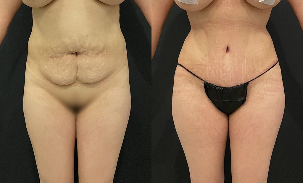 Tummy Tuck Before and After Photo by Jacobson Plastic Surgery in Beverly Hills CA