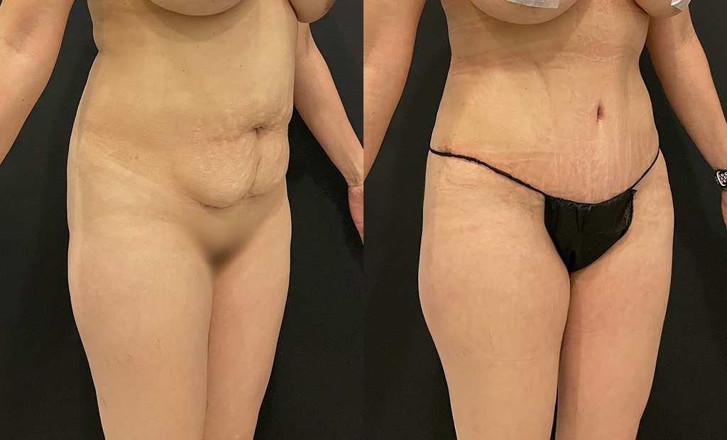 Tummy Tuck Before and After Photo by Jacobson Plastic Surgery in Beverly Hills CA