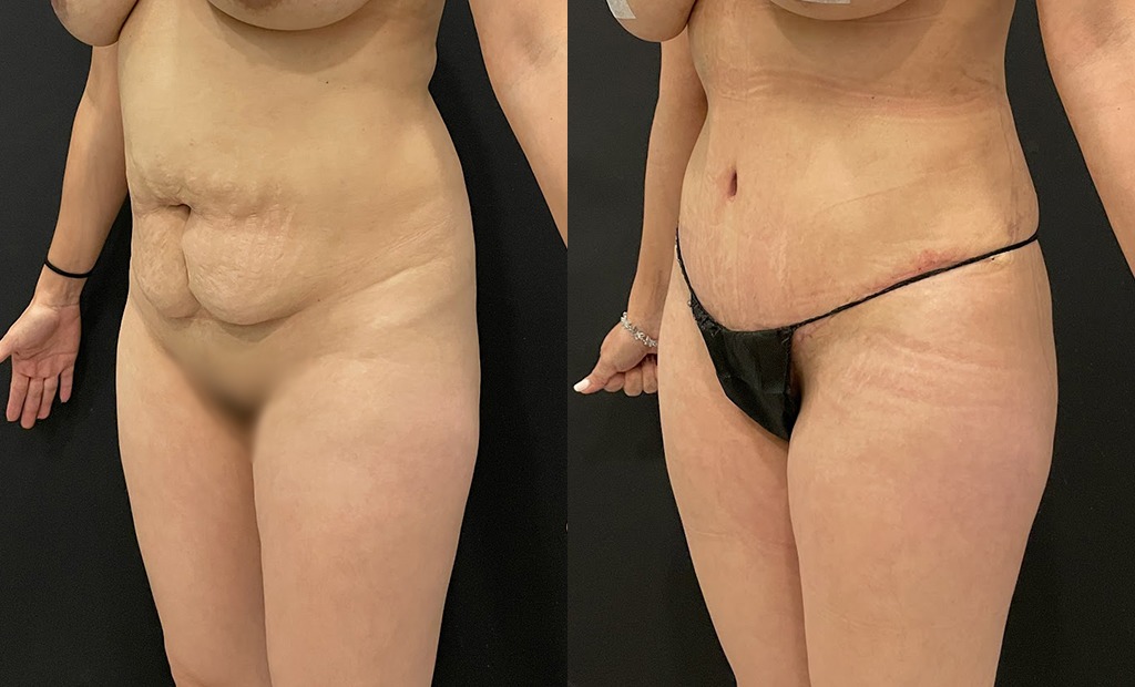 Tummy Tuck Before and After Photo by Jacobson Plastic Surgery in Beverly Hills CA